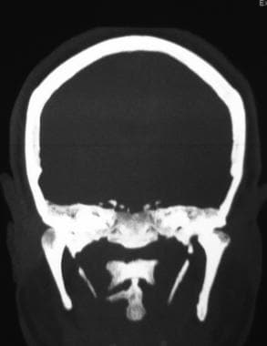 Eagle Syndrome Workup: Laboratory Studies, Imaging Studies, Diagnostic ...