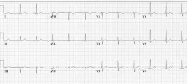 unstable angina ecg