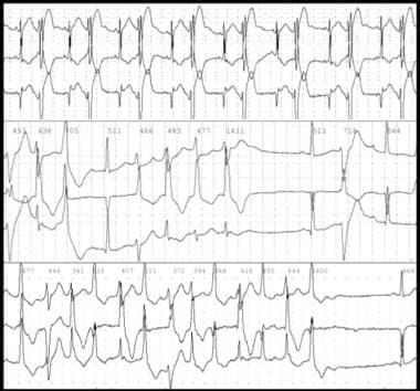 Bidirectional tachycardia in a patient with digita