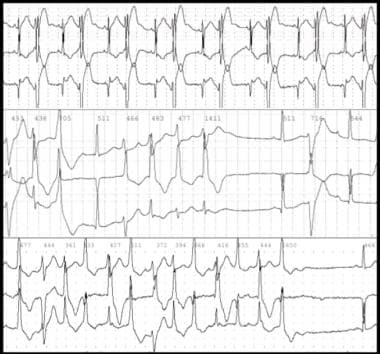 Digitalis Toxicity. Bidirectional tachycardia in a