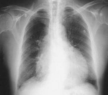 pericardial effusion x ray