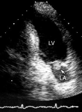 Transthoracic echocardiogram of a left atrial myxo