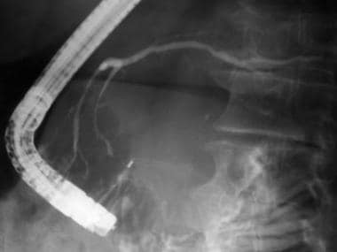 Chronic pancreatitis. Pancreatogram in a patient w