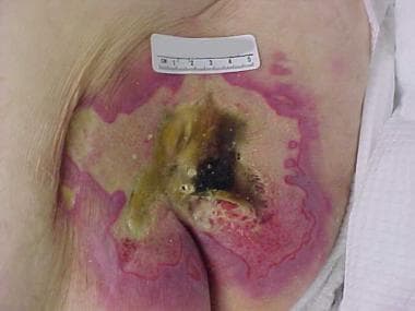 Image of advanced sacral pressure ulcer shows the 