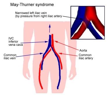 May-Thurner syndrome 