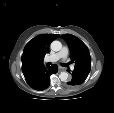 Patient showing a type B aortic dissection with ex