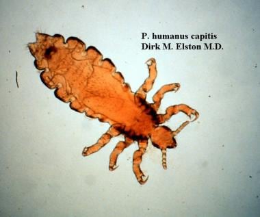 The head louse, Pediculus humanus capitis, has an 