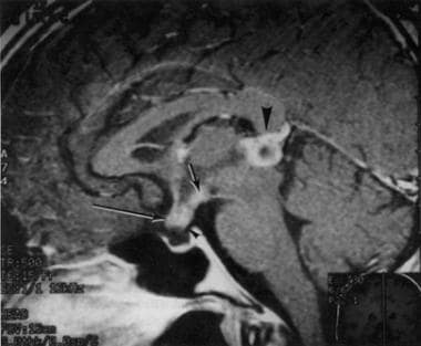 一名33岁女性的钆增强MRI