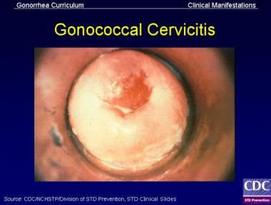 In women with gonococcal cervicitis, the cervix ma
