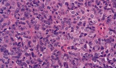 Cellular ependymoma. Cells with a high nuclear-cyt