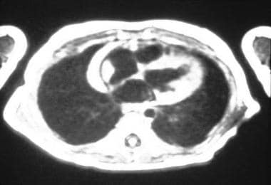Atrial rhabdomyoma as seen on cardiac CT scan in a
