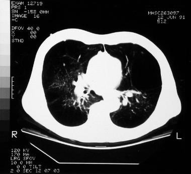 Severe bullous disease as seen on a computed tomog