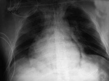This chest radiograph shows pneumomediastinum (rad