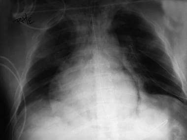 Chest radiograph shows pneumomediastinum (radioluc