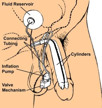 cum să  i mângâi penisul ce exerciții ajută la o erecție