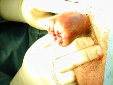 Repair of partial penile amputation after primary 