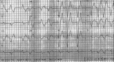 Widened QRS complexes in hyperkalemia. 