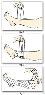 Sea Snake Envenomation Treatment & Management: Prehospital Care ...