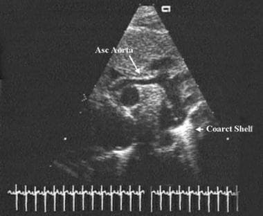 This echocardiographic still frame shows a long-ax