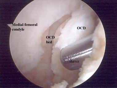Arthroscopic view of medial femoral condyle osteoc