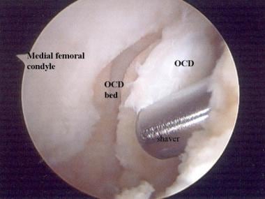 股内侧髁骨的关节镜视图