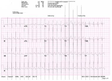 一个3个月大的左心室女性的心电图