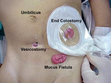 Multiple stomas in abdomen of 3-year-old child who