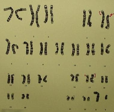 G-banded karyotype of a carrier father [46,XY,t(5;