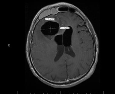 Axial MRI image of a patient with acute frontal si