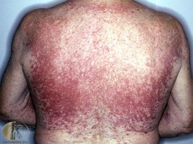 ataxia telangiectasia skin