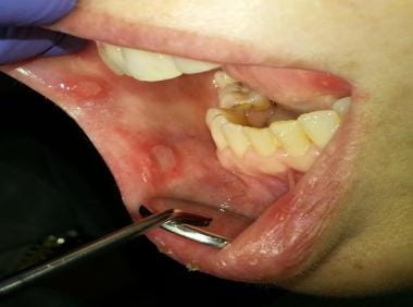 Recurrent aphthous stomatitis with ulcers of varyi