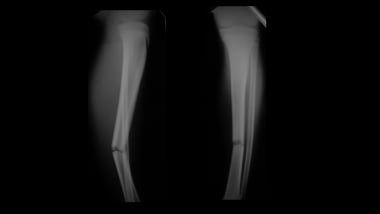 Growth plate (physeal) fractures. Tibia shaft frac