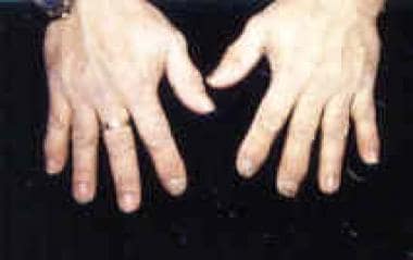 pikkelysömör a kezeken tünetek és kezelés fotó