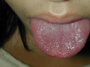 Strawberry tongue. 