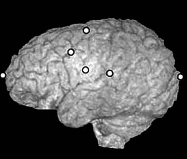 Craniosynostosis management. A 3-dimensional MRI e