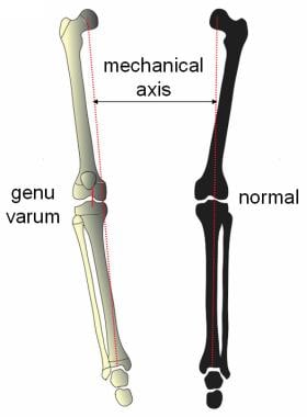 Pediatric Genu Varum: Practice Essentials, Pathophysiology, Etiology