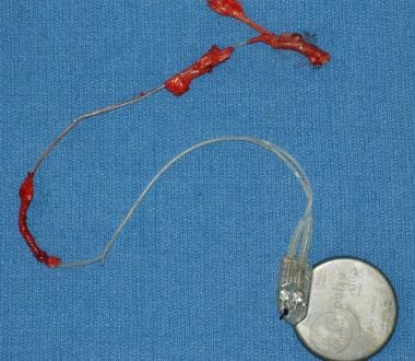 An nerve stimulator after removal at autopsy. Note