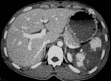 CT scan of abdomen demonstrating grade IV injury o