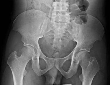 Anterior-posterior radiograph of pelvis, demonstra