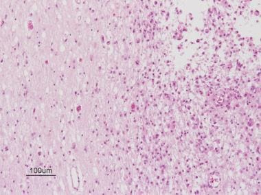 Pathology of Periventricular Leukomalacia. Microsc