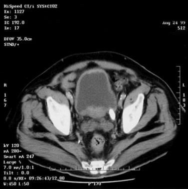 Nonobstructing distal left ureteral calculus 2 × 1