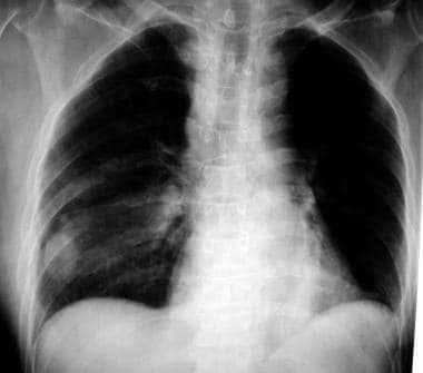 A right lower lobe solitary pulmonary nodule that 