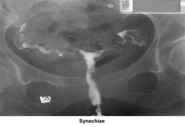 Infertility. Synechiae. Image courtesy of Jairo E.