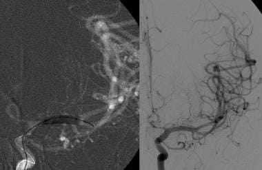 Angiographic view in the same patient (image on le