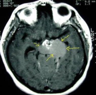 T1-weighted MRI of a 23-year-old woman (same patie