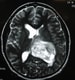 Imaging in Glioblastoma Multiforme