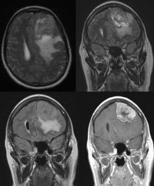 MRI of the brain with the following sequences: axi