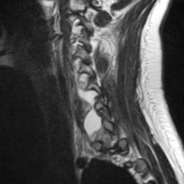 Avulsion in a 17-year-old female adolescent after 