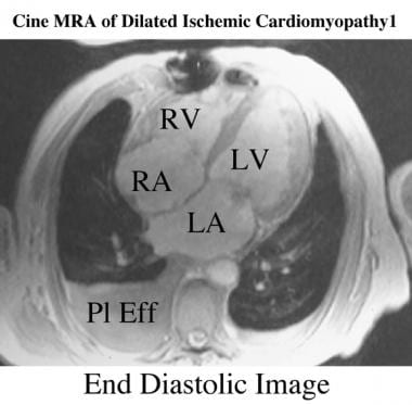 Oblique axial end-diastolic breath-hold cine magne