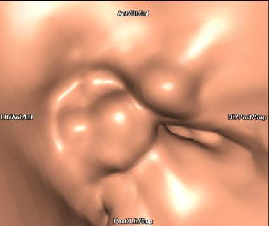 Volume-rendered 3-dimensional CT scan shows a meta